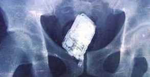 Sembra essere vero che i cellulari provocano, purtroppo, tumori al cervello, calcoli renali e malattie cardiache